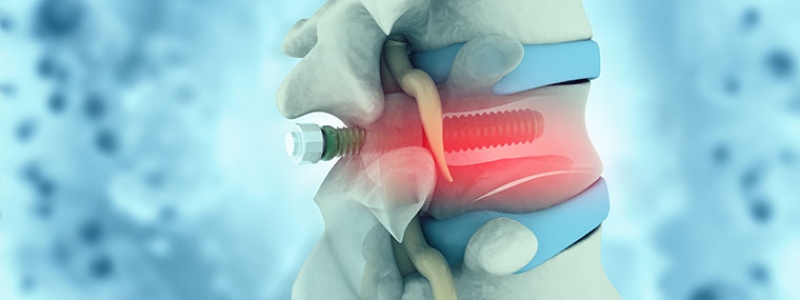 Qualitätskontrolle bei der Herstellung medizinischer Implantate