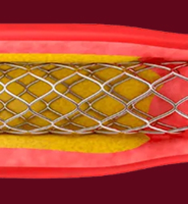 Stent-Inspektion